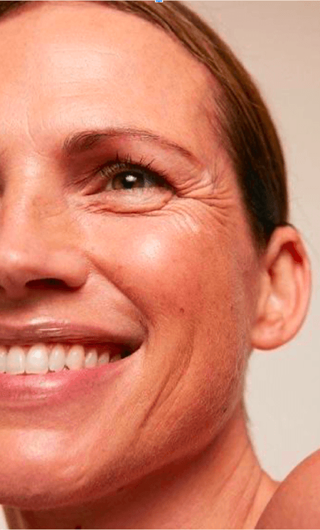 Rhinoplasty
